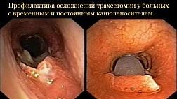 Профилактика осложнений трахестомии у больных с временным и постоянным канюленосителем Методические рекомендации 2020